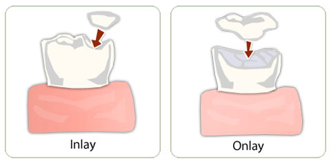 inlay-onlay-zubne-plomby-1