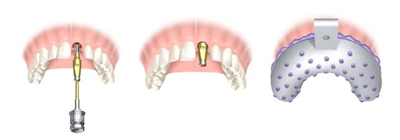 La fixation de la vis de l'implant et la prise des empreintes